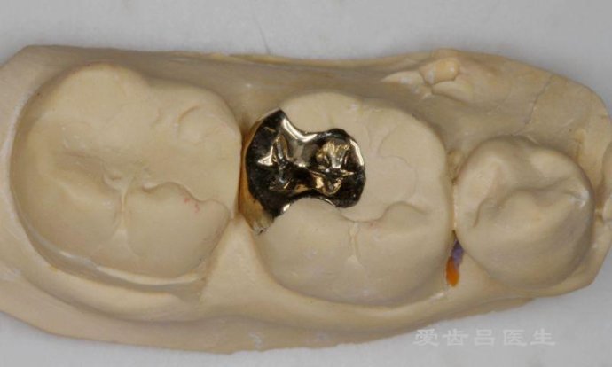 齲齒需要及時補牙