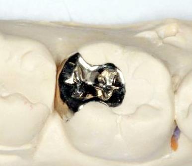 齲齒**要及時補牙