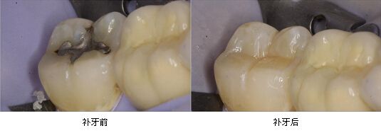 愛康健3M納米樹脂補牙