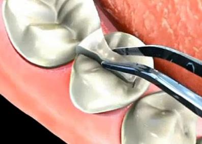 深圳補牙的過程是什麽(me) 樣子的