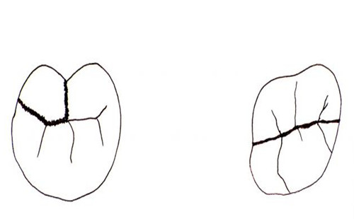 龍華牙齒開裂怎麽(me) 辦?