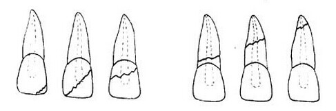 牙齒上有裂紋怎麽(me) 辦