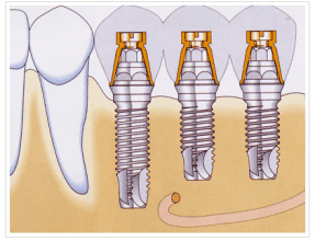 種植牙壽命受哪些方麵影響，如何做好種植牙的護理