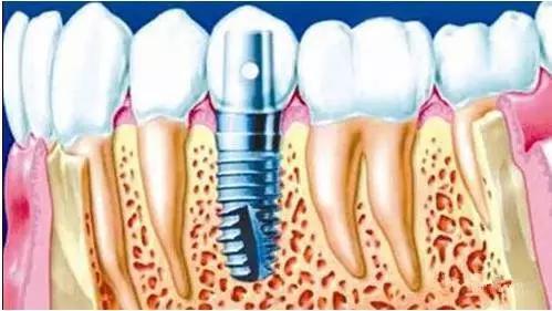 有這些疾病 千萬(wan) 不能種植牙！ 
