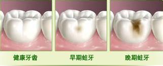 蛀牙過程示意圖