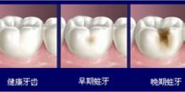 愛康健蛀牙修複結果圖