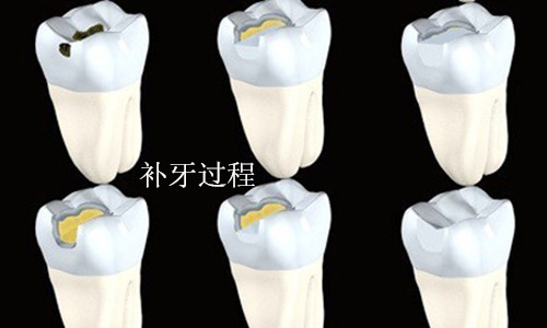 補牙的壽命大概是多久呢?