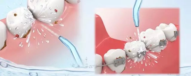 深圳洗白牙齒多少錢