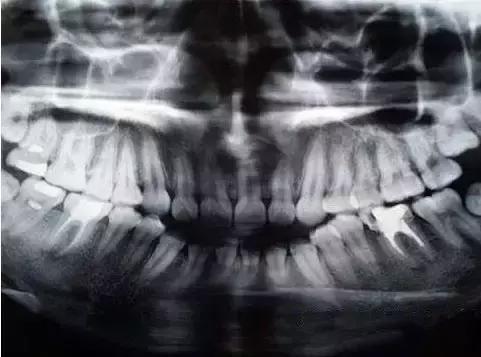 補完牙後牙疼，怎樣用筷子判別是否需要根管治療呢？