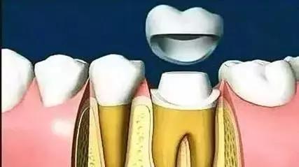 補完牙後牙疼，怎樣用筷子判別是否需要根管治療呢？