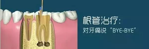 補完牙後牙疼，怎樣用筷子判別是否需要根管治療呢？