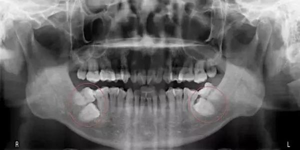 真or假 牙科X光檢查盡量少做?