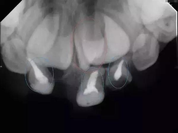 真or假 牙科X光檢查盡量少做?