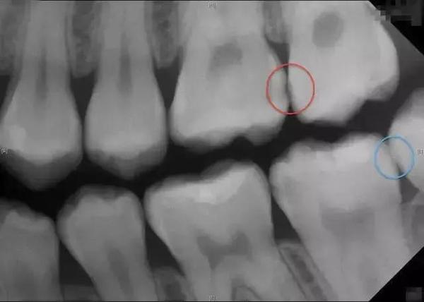 真or假 牙科X光檢查盡量少做?