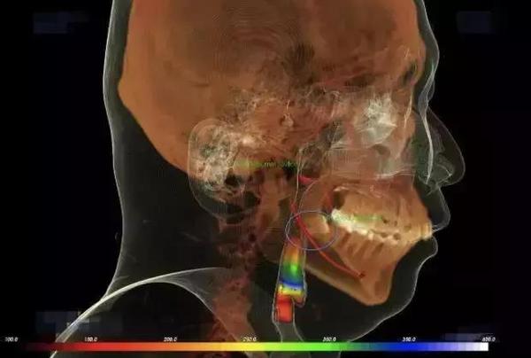 真or假 牙科X光檢查盡量少做?