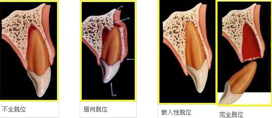 當牙齒“脫臼”以後，產(chan) 生的並發症會(hui) 很嚴(yan) 重