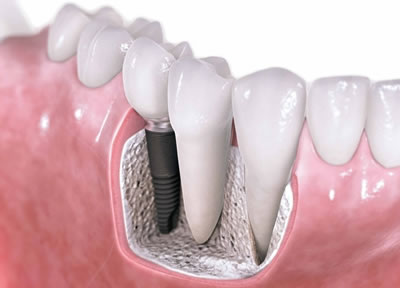 深圳關(guan) 於(yu) 種植牙常見的三個(ge) 問題