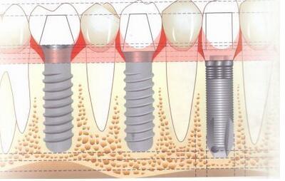 種植牙有哪些適應症與(yu) 禁忌症？