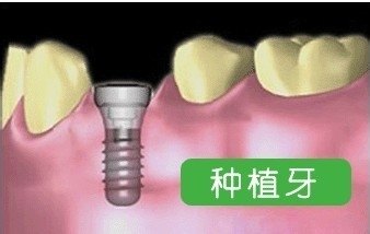 為(wei) 什麽(me) 國外把種植牙作為(wei) 修複缺牙的方式？