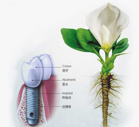 即刻種植牙手術會(hui) 疼嗎？