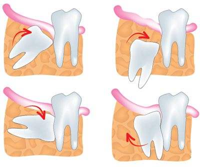  長立世牙牙疼怎麽(me) 辦 