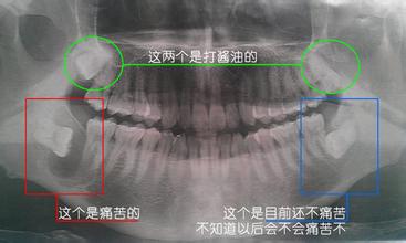 拔立世牙有危險嗎