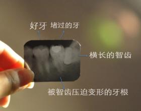 孕婦長立世牙怎麽(me) 辦？