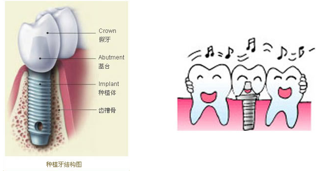 深圳即刻種植牙多少錢 