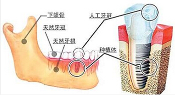 深圳一顆即刻種植牙費用是多少錢