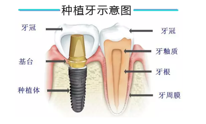 深圳即刻種植牙一般多少錢一顆