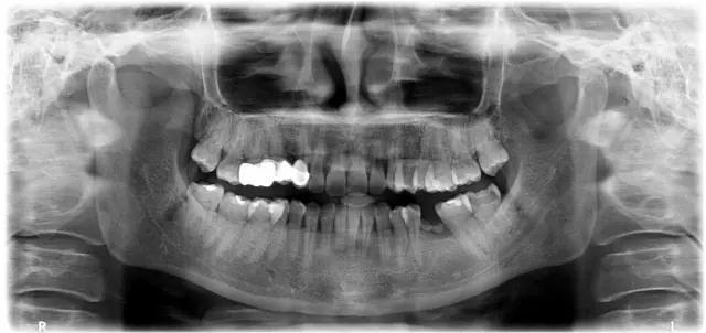深圳一顆種植牙費用多少 看種植牙的過程就知道