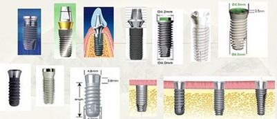深圳一顆種植牙費用多少 看種植牙的過程就知道