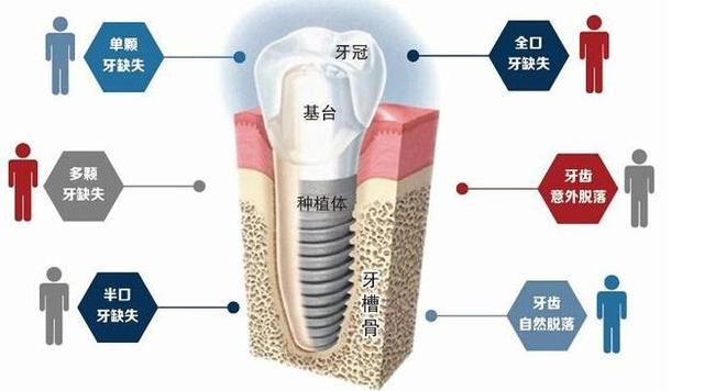種植牙為(wei) 什麽(me) 這麽(me) 貴？