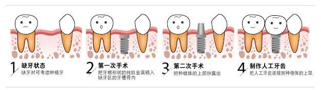 深圳種植牙一般多少錢一顆