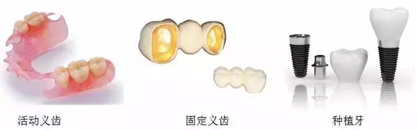 假牙修複大pk，即刻種植牙一招製勝？