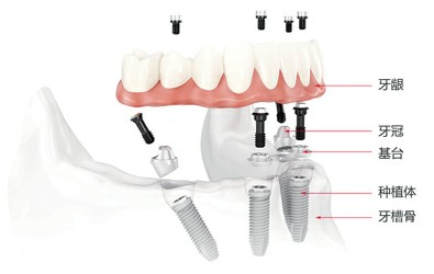 假牙修複大pk，即刻種植牙一招製勝？