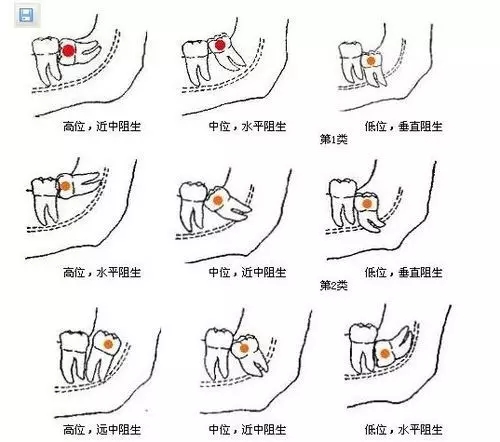 拔與(yu) 不拔？讓都市人糾結的“立事牙”