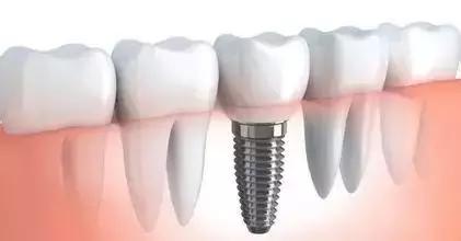 深圳微創即刻種植牙要多少錢