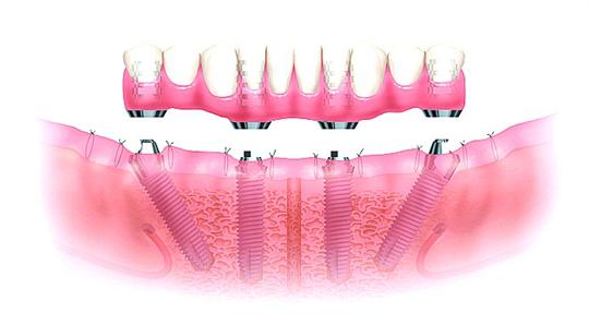 即刻種植牙真的隻有優(you) 點，沒有危害嗎？