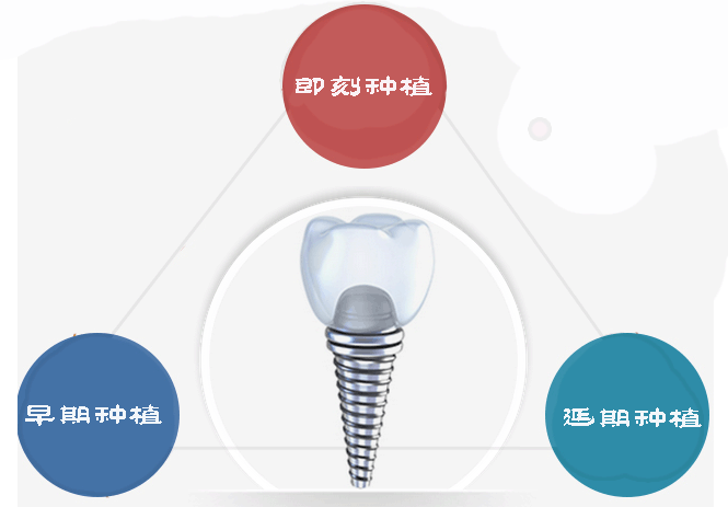種植牙怎麽(me) 樣,種植牙好嗎