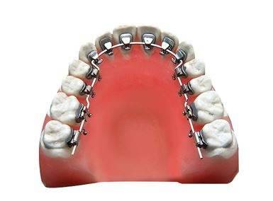 舌側(ce) 隱形矯正是怎麽(me) 矯正的？多少錢？