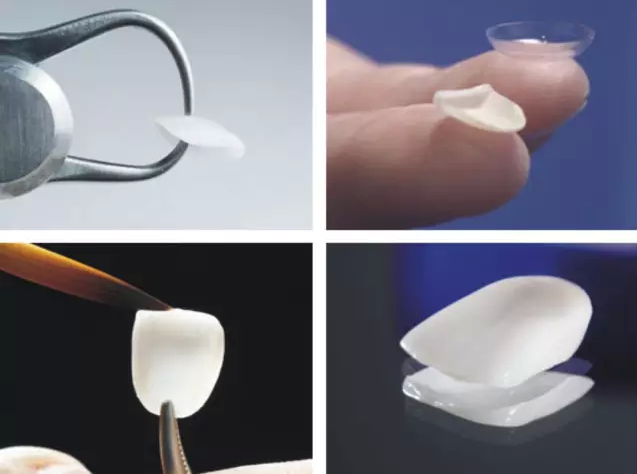 深圳瓷貼麵多少錢一顆