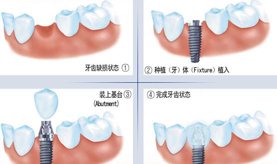 拔牙後多久能做即刻種植牙