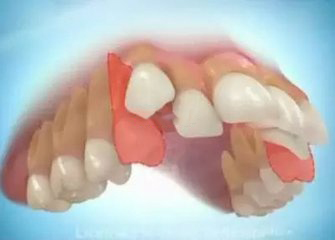 深圳成人門牙不齊想要矯正大概需要多少錢