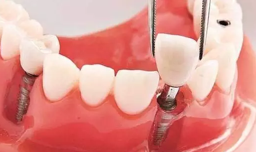 種植牙價(jia) 格怎麽(me) 樣