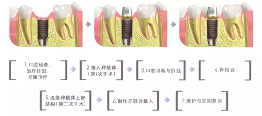 種植牙價(jia) 格是多少