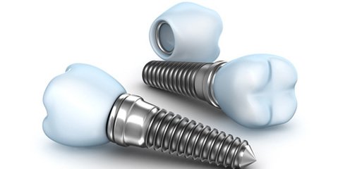 種牙結果怎麽(me) 樣