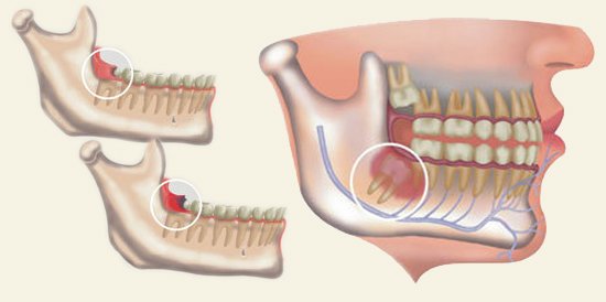 智齒冠周炎治療方法