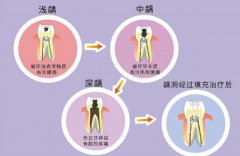 愛康健齒科補牙價目表