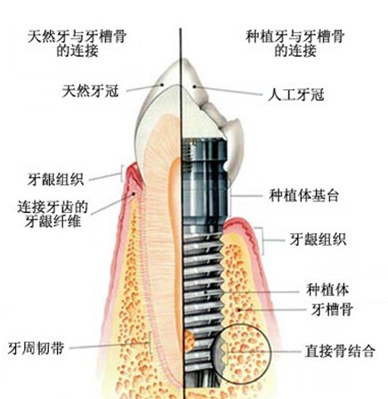種植牙的成功率高不高?